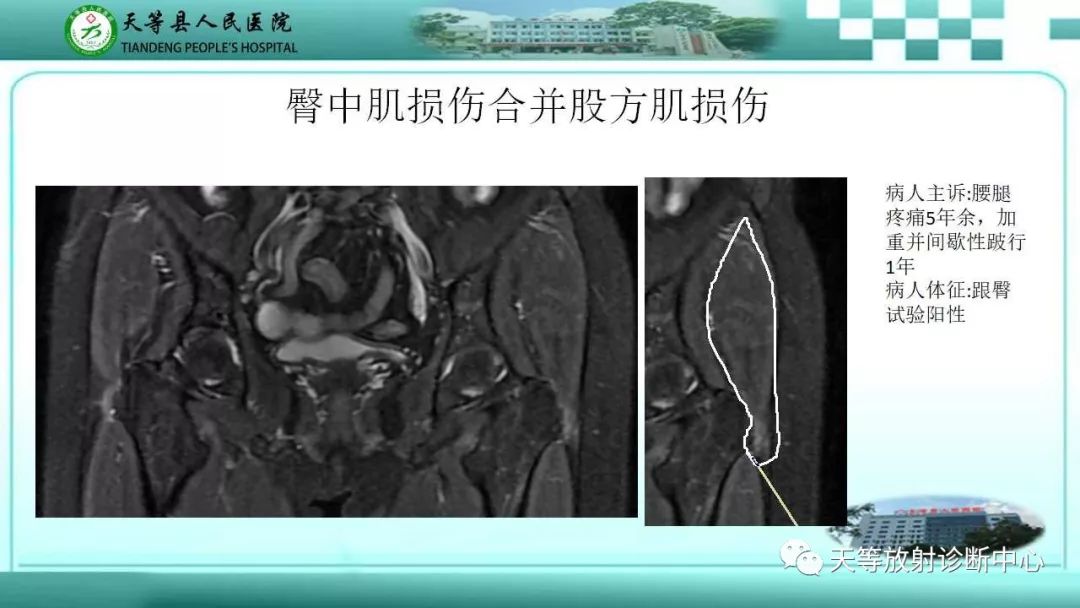 影像PPT - 【PPT】臀中肌损伤-6
