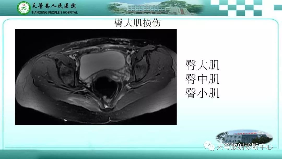 影像PPT - 【PPT】臀中肌损伤-9