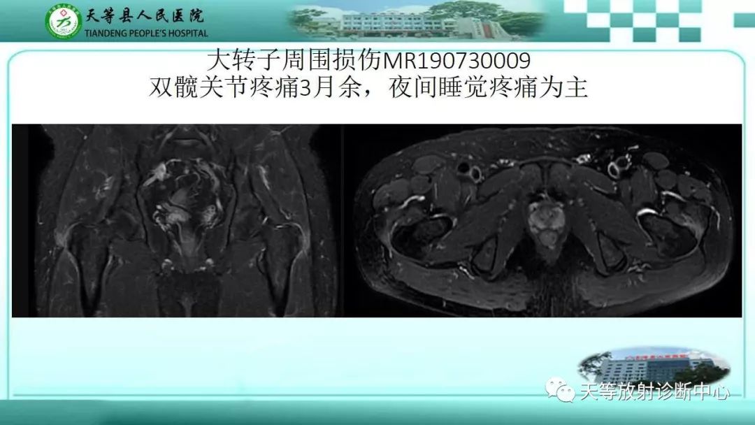 影像PPT - 【PPT】臀中肌损伤-12