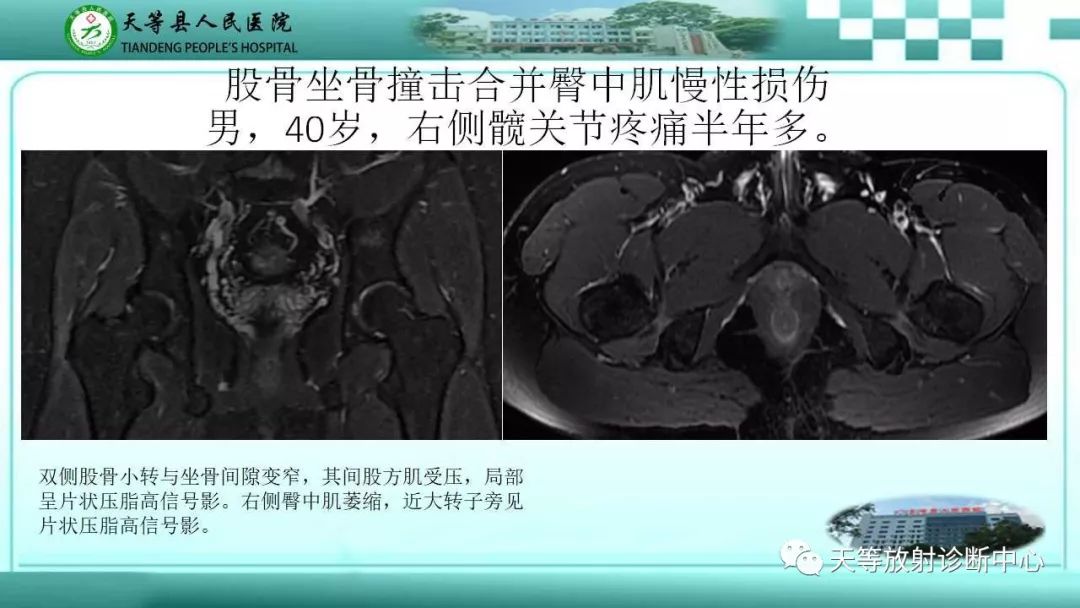 影像PPT - 【PPT】臀中肌损伤-14