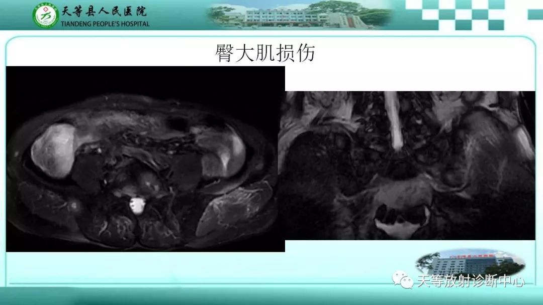 影像PPT - 【PPT】臀中肌损伤-11