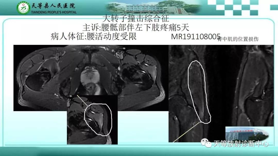 影像PPT - 【PPT】臀中肌损伤-13