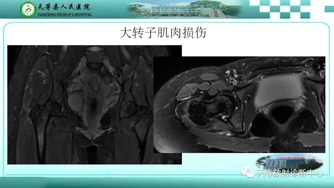 影像PPT - 【PPT】臀中肌损伤-10