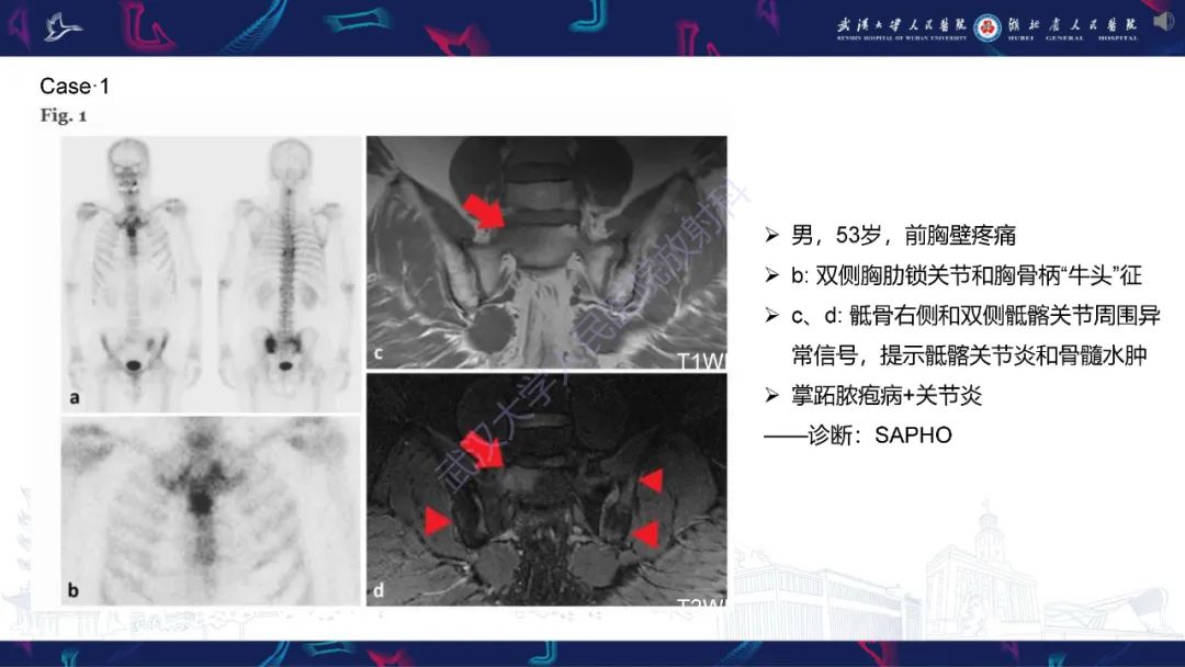 影像PPT - 【PPT】SAPHO综合征影像诊断-14