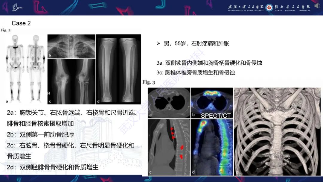 影像PPT - 【PPT】SAPHO综合征影像诊断-15