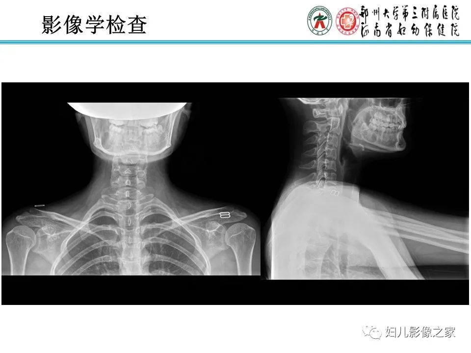 影像PPT - 【病例】牙源性角化囊性瘤1例影像诊断-3