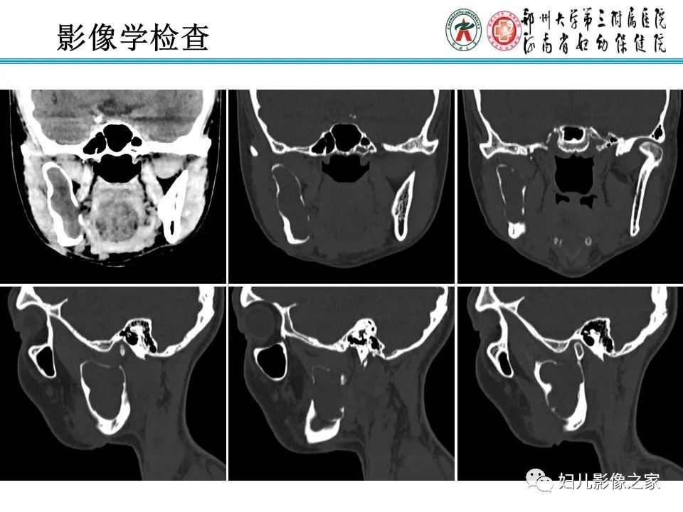 影像PPT - 【病例】牙源性角化囊性瘤1例影像诊断-4