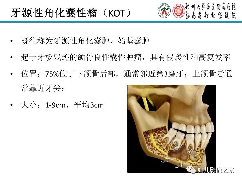 影像PPT - 【病例】牙源性角化囊性瘤1例影像诊断-9