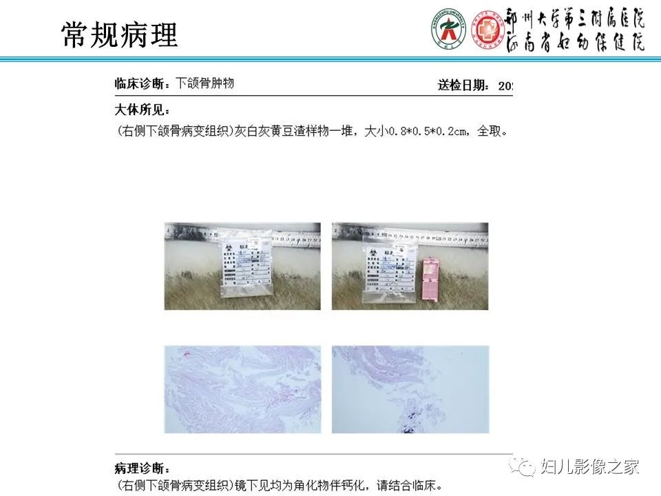 影像PPT - 【病例】牙源性角化囊性瘤1例影像诊断-8