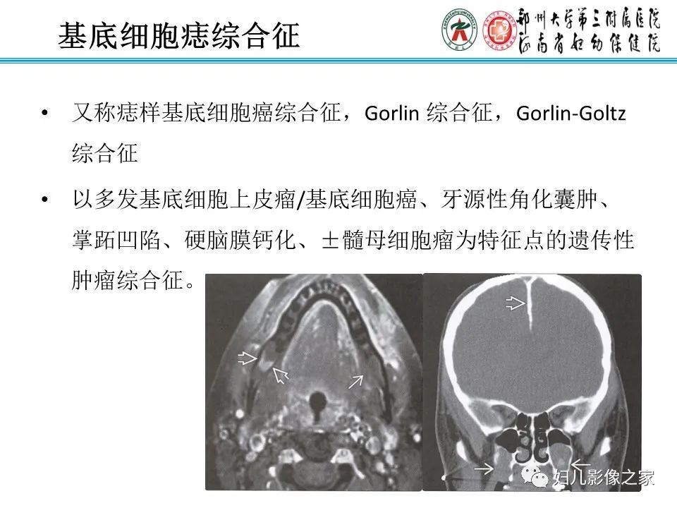 影像PPT - 【病例】牙源性角化囊性瘤1例影像诊断-11