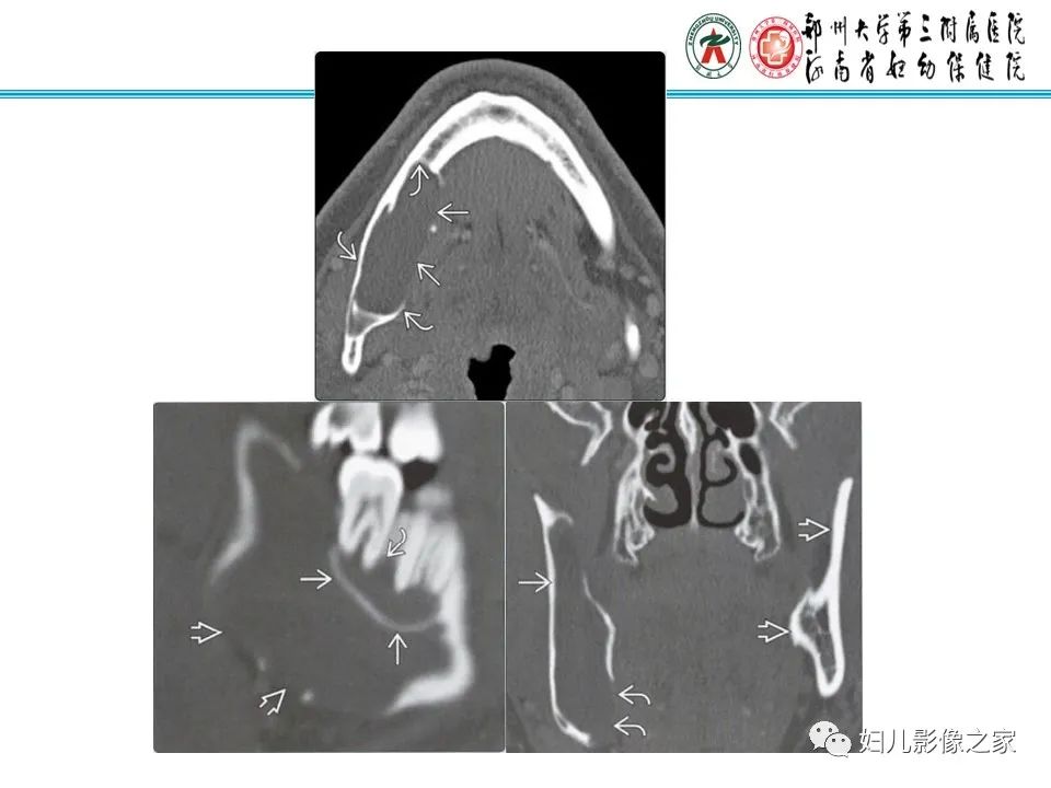 影像PPT - 【病例】牙源性角化囊性瘤1例影像诊断-16