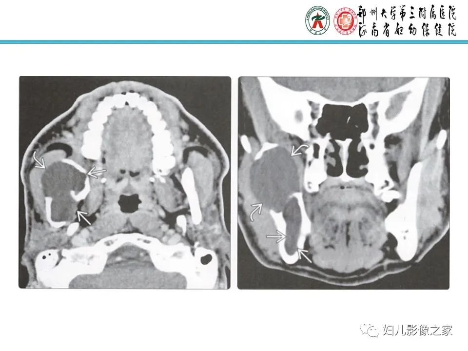 影像PPT - 【病例】牙源性角化囊性瘤1例影像诊断-18