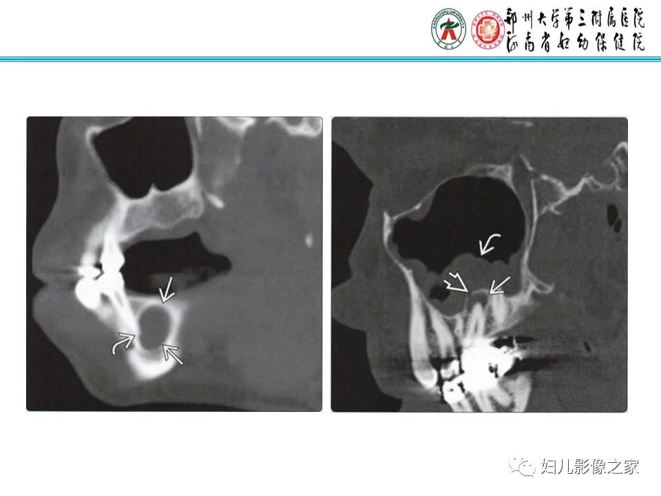 影像PPT - 【病例】牙源性角化囊性瘤1例影像诊断-22