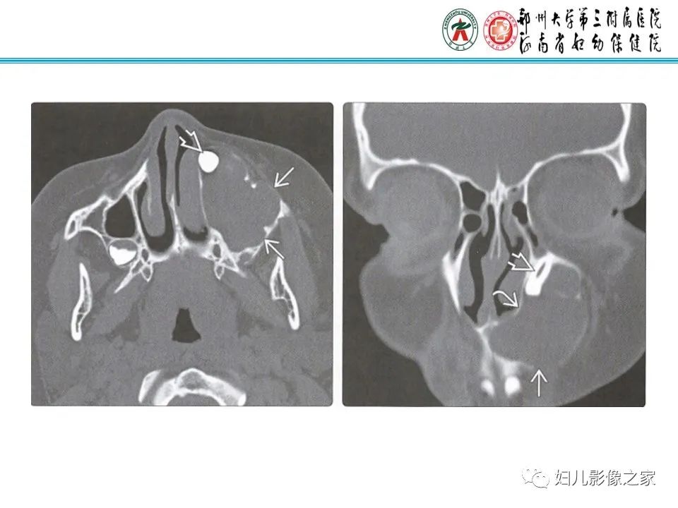 影像PPT - 【病例】牙源性角化囊性瘤1例影像诊断-17