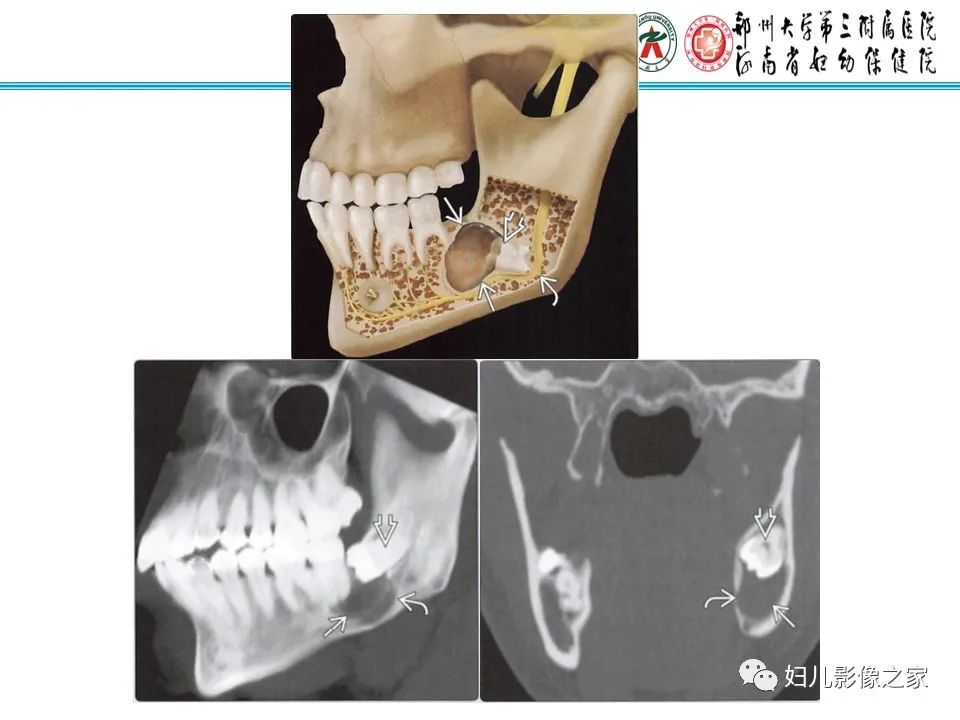 影像PPT - 【病例】牙源性角化囊性瘤1例影像诊断-24