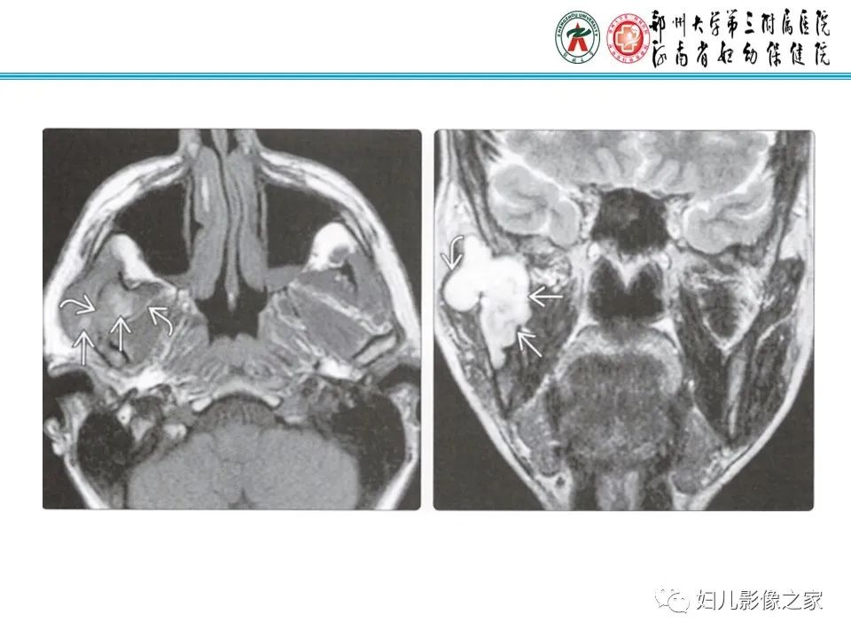 影像PPT - 【病例】牙源性角化囊性瘤1例影像诊断-20