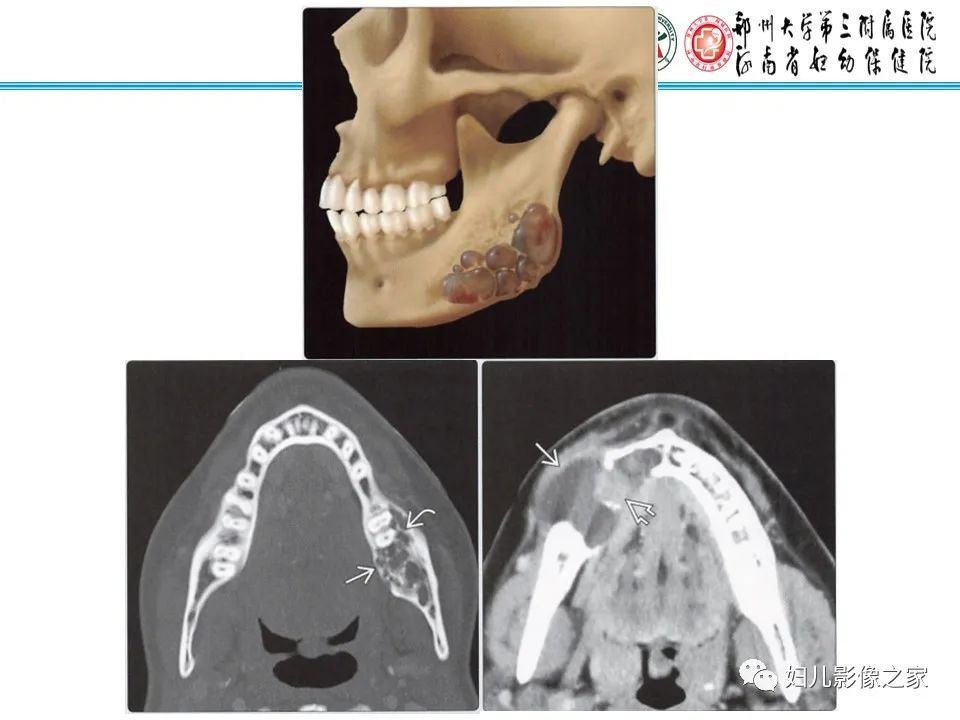 影像PPT - 【病例】牙源性角化囊性瘤1例影像诊断-26