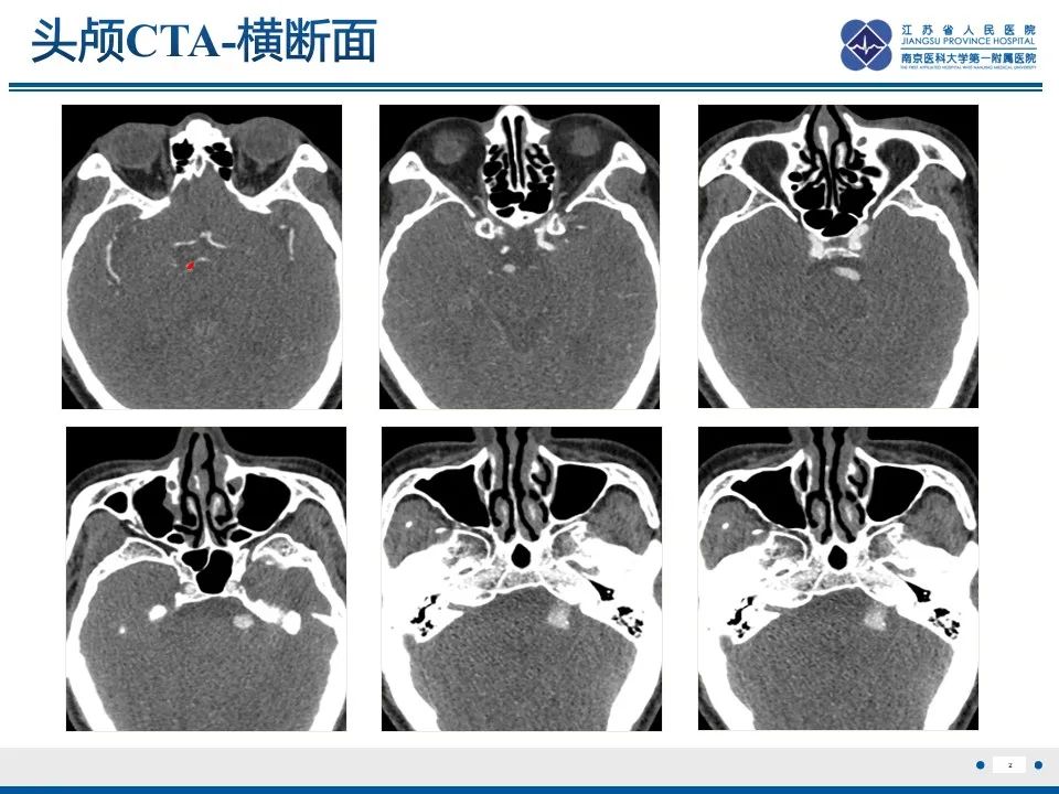 影像PPT - 【PPT】椎基底动脉延长扩张症-3