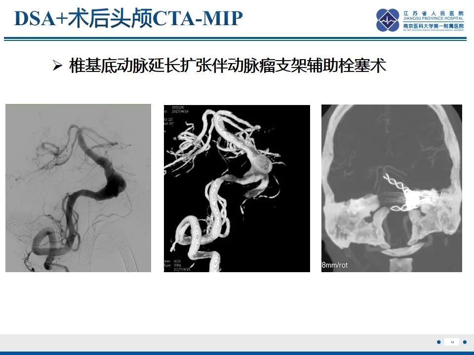 影像PPT - 【PPT】椎基底动脉延长扩张症-13