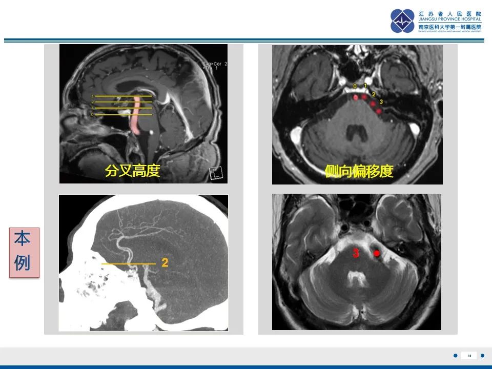 影像PPT - 【PPT】椎基底动脉延长扩张症-16