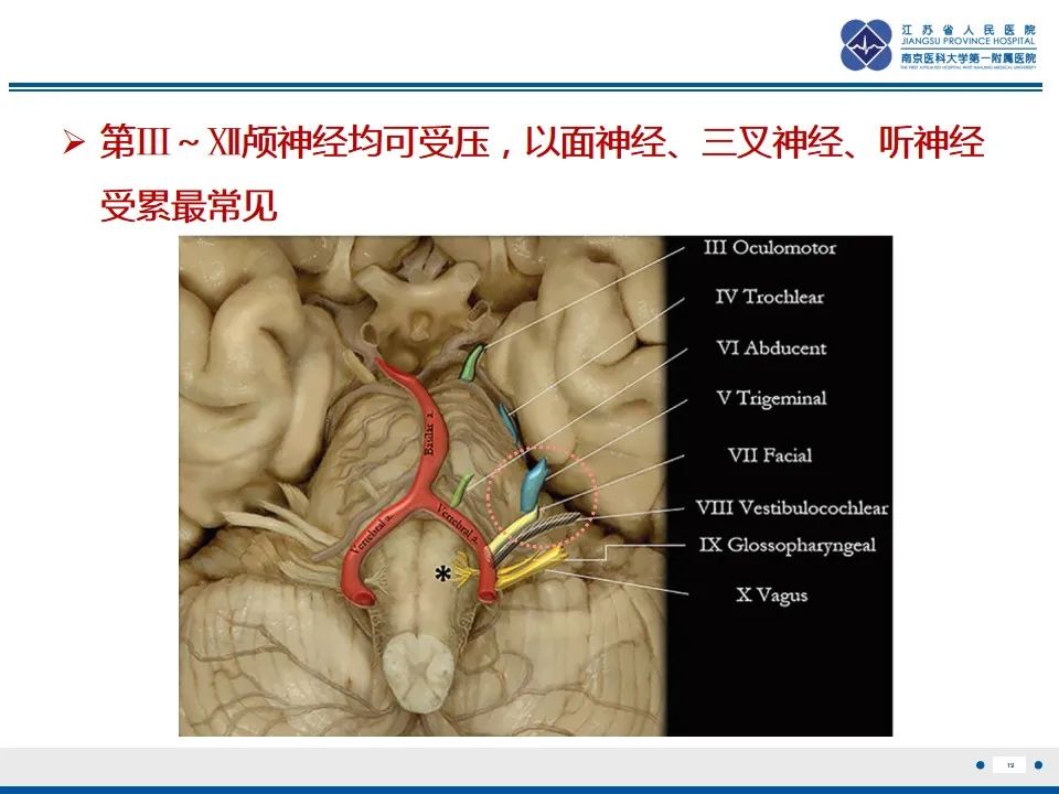 影像PPT - 【PPT】椎基底动脉延长扩张症-20