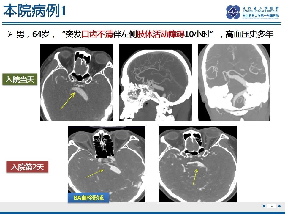 影像PPT - 【PPT】椎基底动脉延长扩张症-28