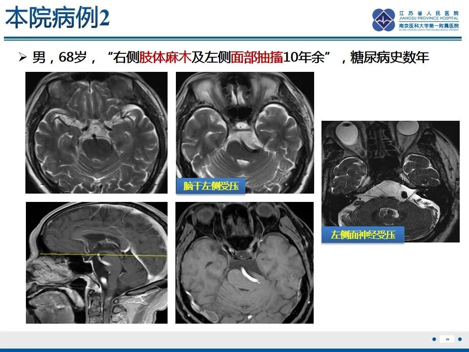 影像PPT - 【PPT】椎基底动脉延长扩张症-29