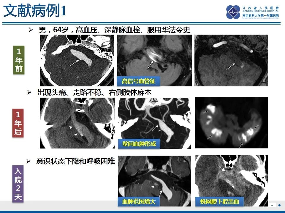 影像PPT - 【PPT】椎基底动脉延长扩张症-30