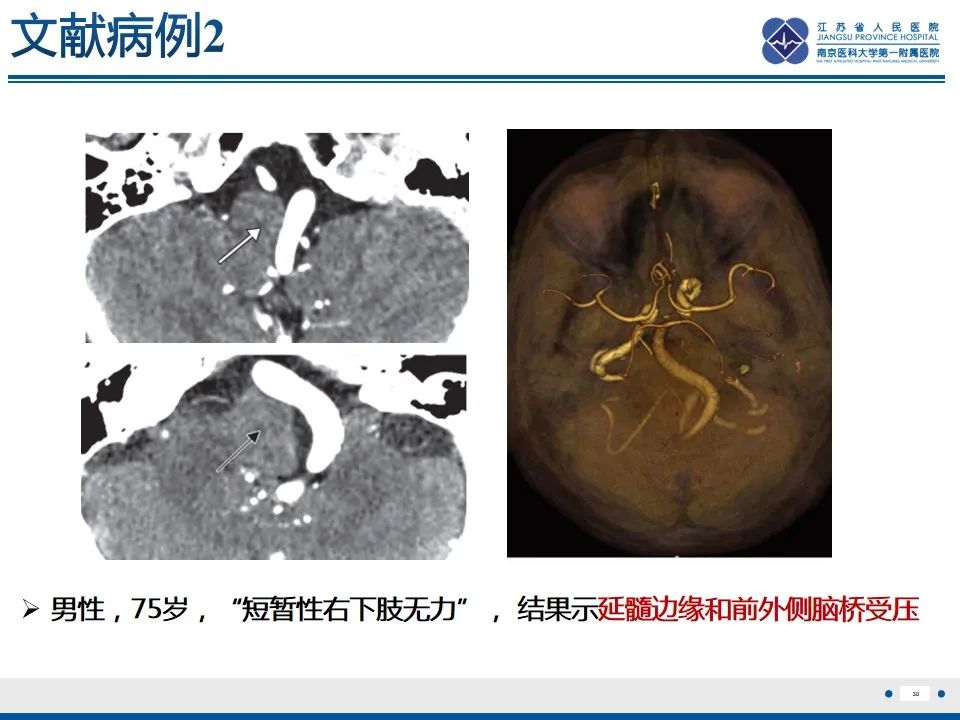 影像PPT - 【PPT】椎基底动脉延长扩张症-31