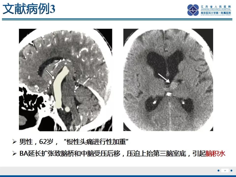 影像PPT - 【PPT】椎基底动脉延长扩张症-32