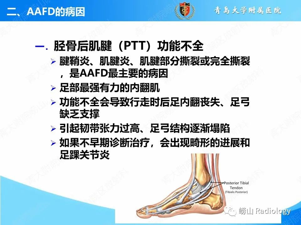影像PPT - 【PPT】成人获得性扁平足（ AAFD ）及其相关损伤的影像诊断-6