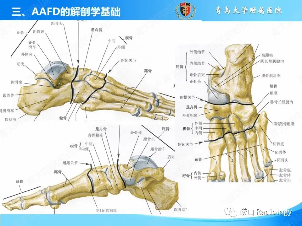 影像PPT - 【PPT】成人获得性扁平足（ AAFD ）及其相关损伤的影像诊断-9