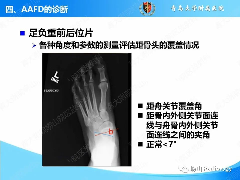 影像PPT - 【PPT】成人获得性扁平足（ AAFD ）及其相关损伤的影像诊断-15