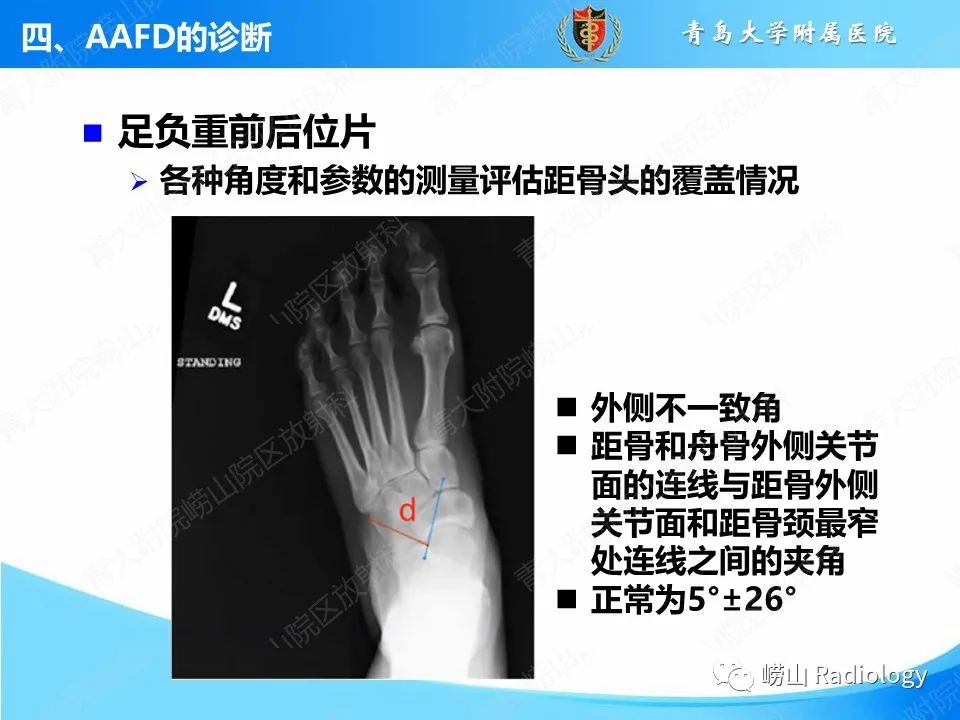 影像PPT - 【PPT】成人获得性扁平足（ AAFD ）及其相关损伤的影像诊断-17