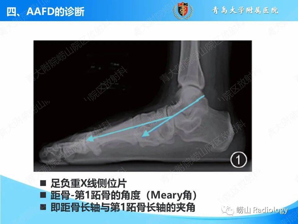 影像PPT - 【PPT】成人获得性扁平足（ AAFD ）及其相关损伤的影像诊断-19