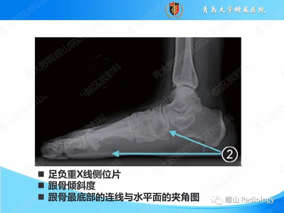 影像PPT - 【PPT】成人获得性扁平足（ AAFD ）及其相关损伤的影像诊断-20