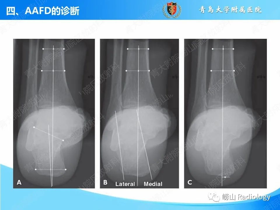 影像PPT - 【PPT】成人获得性扁平足（ AAFD ）及其相关损伤的影像诊断-23