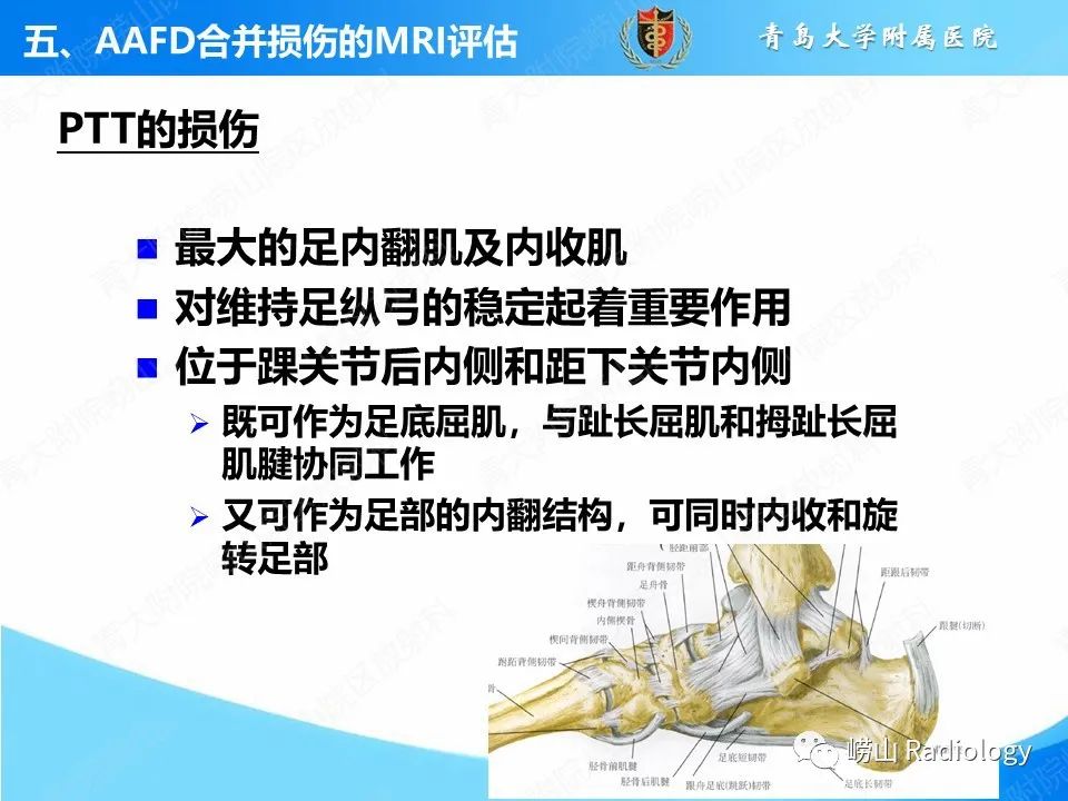 影像PPT - 【PPT】成人获得性扁平足（ AAFD ）及其相关损伤的影像诊断-26