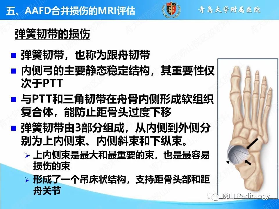 影像PPT - 【PPT】成人获得性扁平足（ AAFD ）及其相关损伤的影像诊断-31