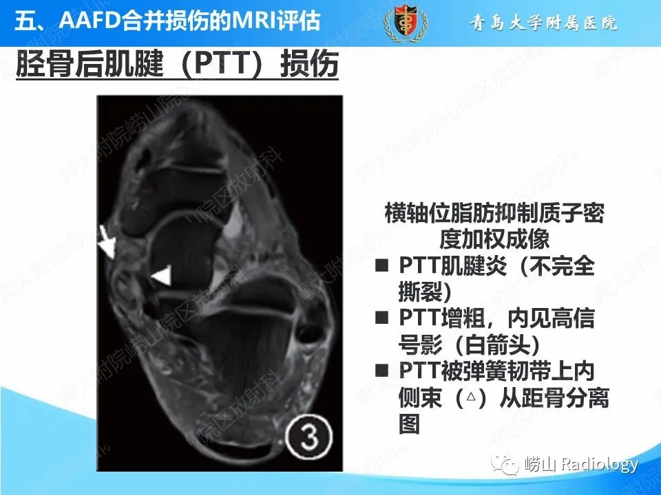影像PPT - 【PPT】成人获得性扁平足（ AAFD ）及其相关损伤的影像诊断-30