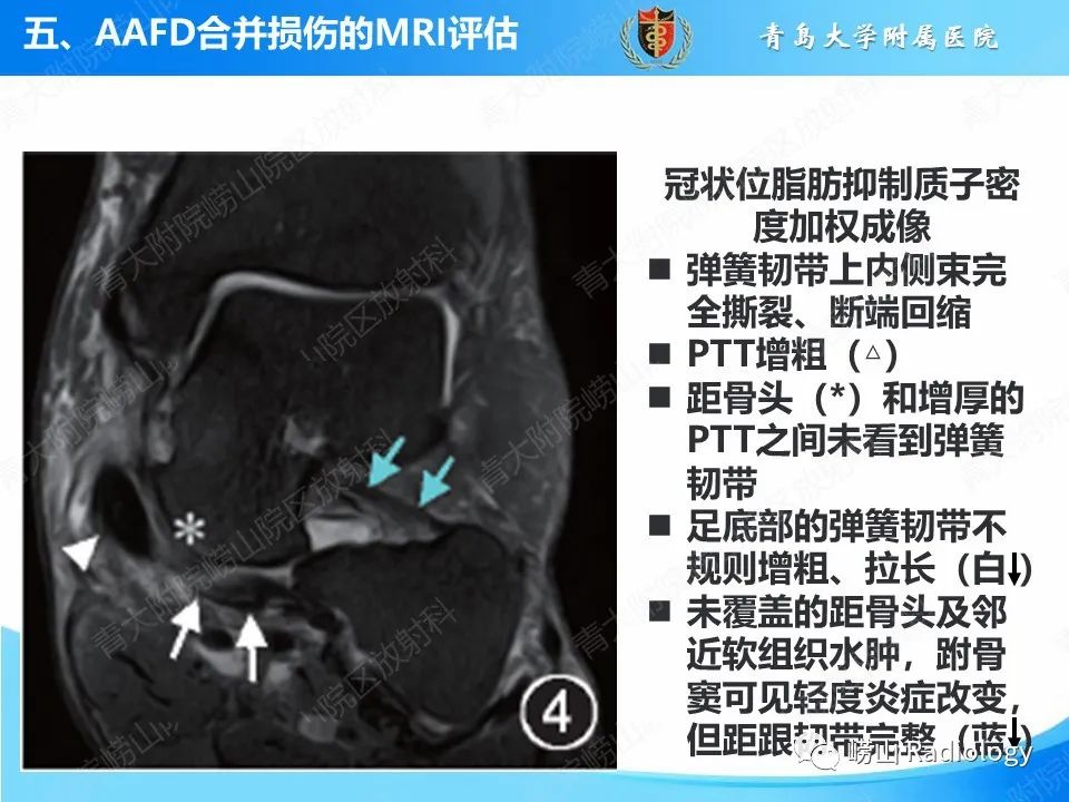 影像PPT - 【PPT】成人获得性扁平足（ AAFD ）及其相关损伤的影像诊断-34