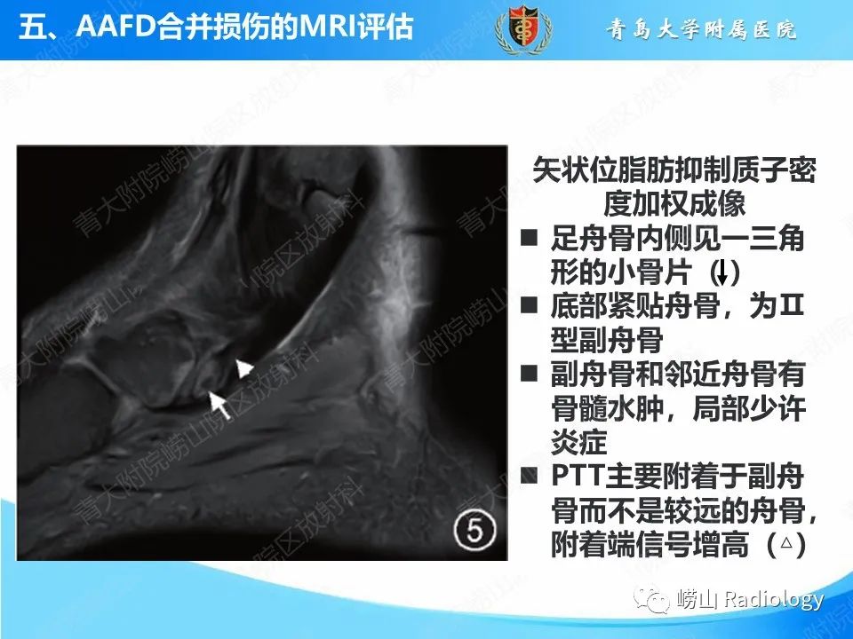 影像PPT - 【PPT】成人获得性扁平足（ AAFD ）及其相关损伤的影像诊断-37
