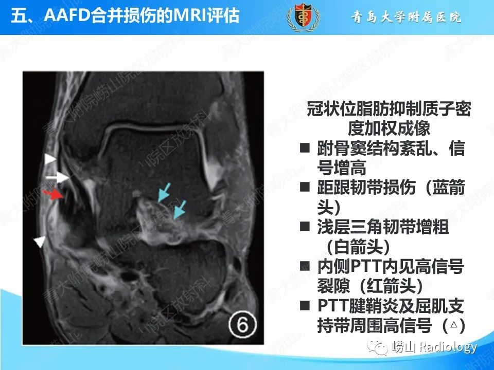影像PPT - 【PPT】成人获得性扁平足（ AAFD ）及其相关损伤的影像诊断-39