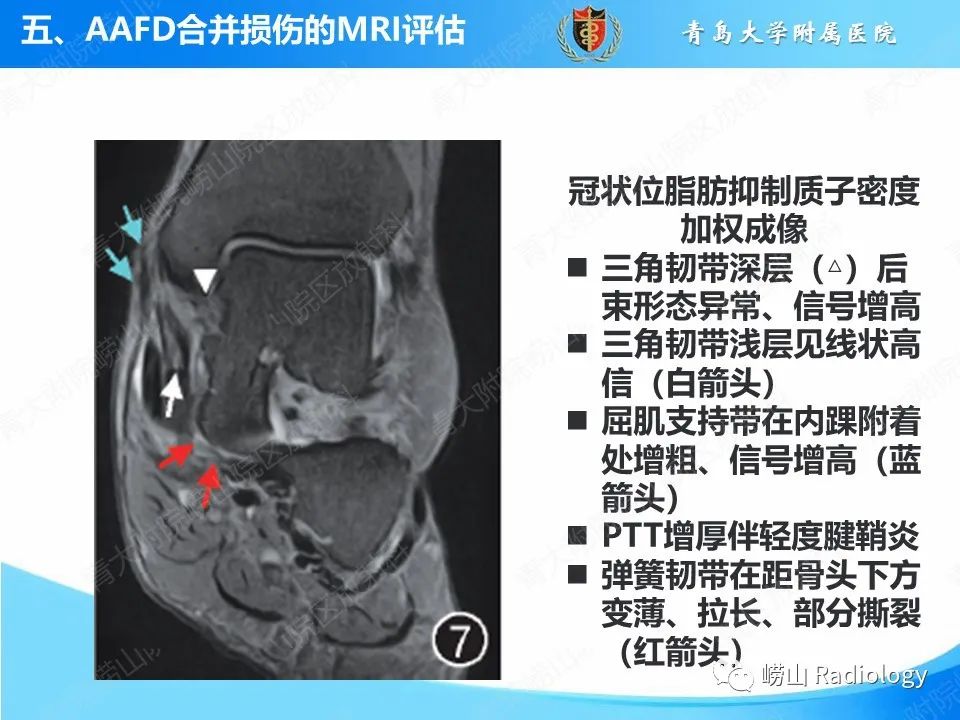 影像PPT - 【PPT】成人获得性扁平足（ AAFD ）及其相关损伤的影像诊断-42