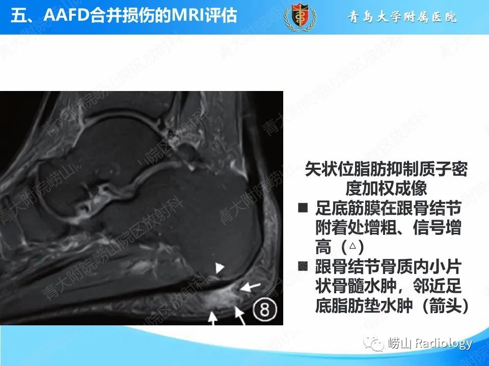 影像PPT - 【PPT】成人获得性扁平足（ AAFD ）及其相关损伤的影像诊断-45