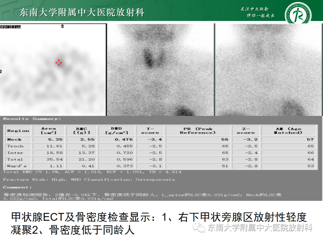影像PPT - 【PPT】原发性甲状旁腺功能亢进-5 影像PPT - 【PPT】原发性甲状旁腺功能亢进-5