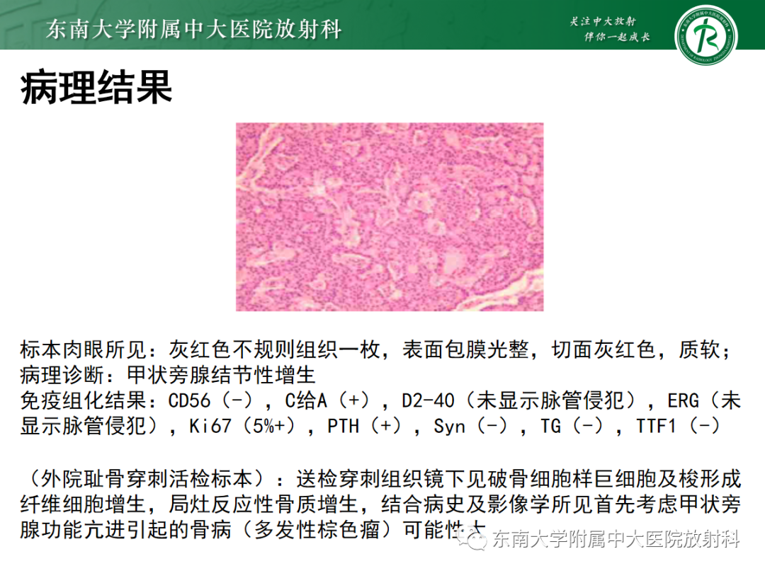 影像PPT - 【PPT】原发性甲状旁腺功能亢进-6 影像PPT - 【PPT】原发性甲状旁腺功能亢进-6