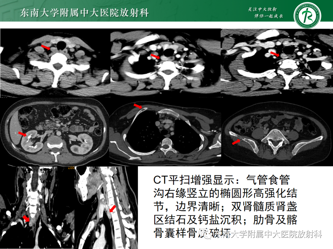 影像PPT - 【PPT】原发性甲状旁腺功能亢进-4 影像PPT - 【PPT】原发性甲状旁腺功能亢进-4