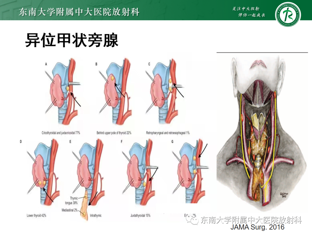 影像PPT - 【PPT】原发性甲状旁腺功能亢进-11 影像PPT - 【PPT】原发性甲状旁腺功能亢进-11