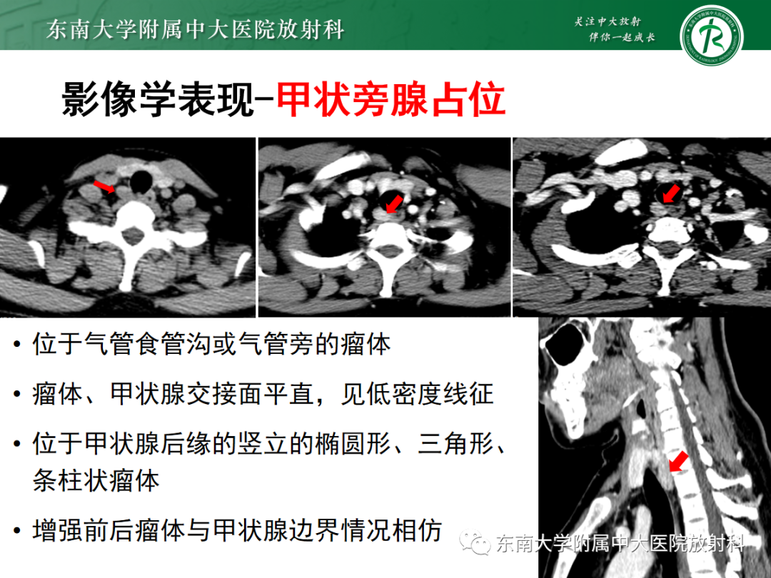 影像PPT - 【PPT】原发性甲状旁腺功能亢进-17 影像PPT - 【PPT】原发性甲状旁腺功能亢进-17